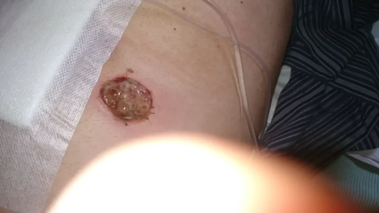 A close-up of the blog author’s healing postoperative opening on the abdomen