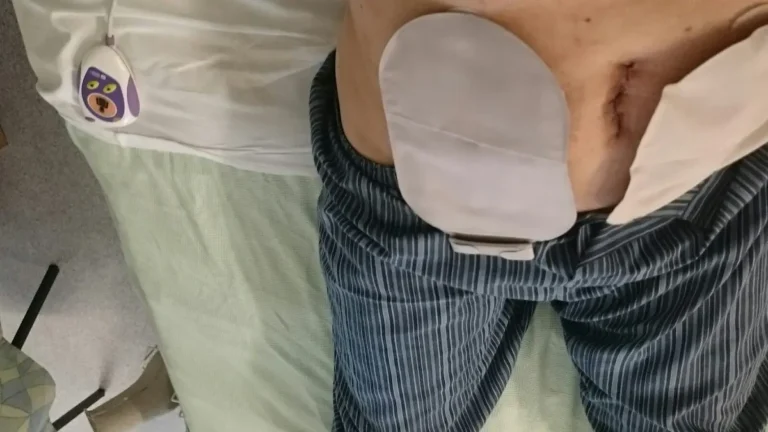 A man's abdomen after surgery, with two stoma bags on either side.